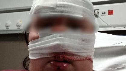 Suite à son accident, Céline a eu le visage défiguré et des soins chaque jour pendant plus de trois mois.